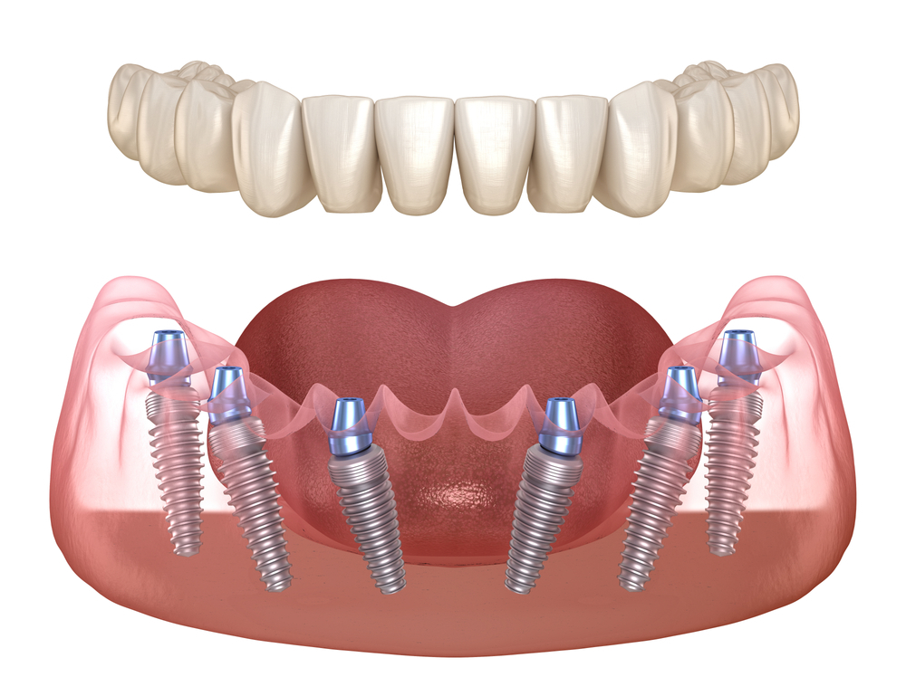 DENTAL IMPLANTS IN DUBAI: 6 MYTHS DEBUNKED