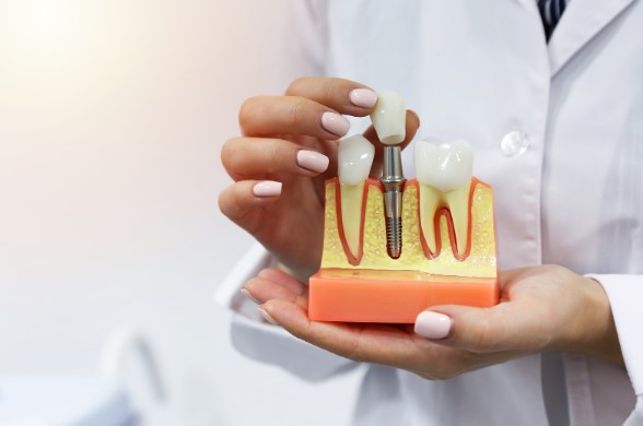 Caring for Your Dental Implants: Tips for Maintaining a Healthy Smile