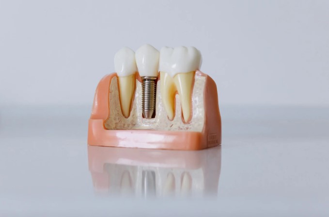 dental implant