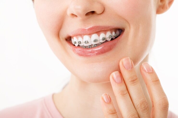 Tips for Maintaining Excellent Oral Hygiene While Wearing Braces