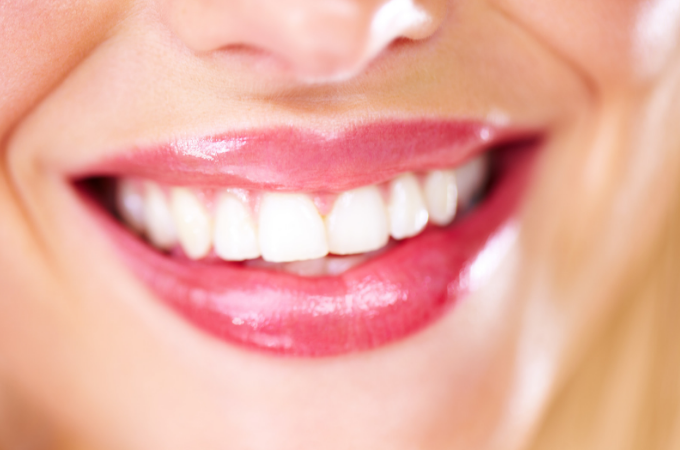 Teeth whitening