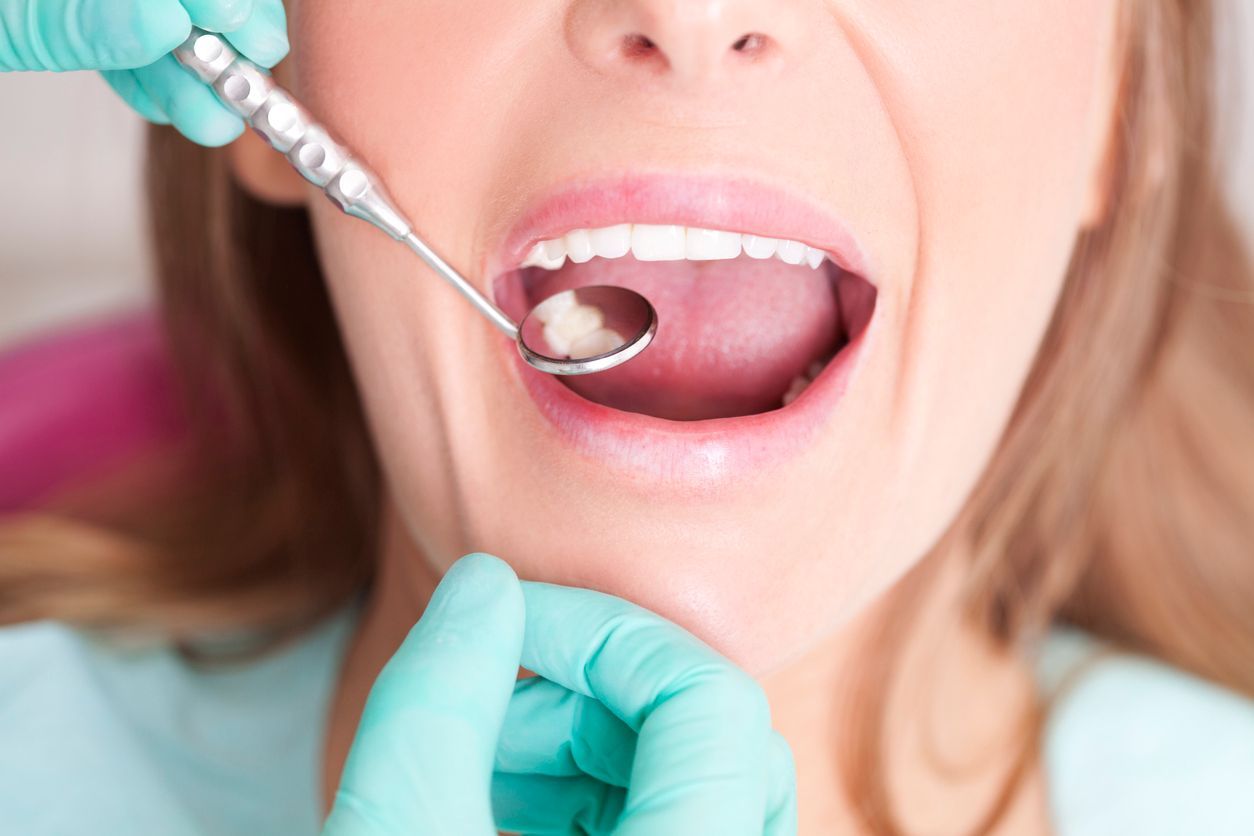 dental fillings