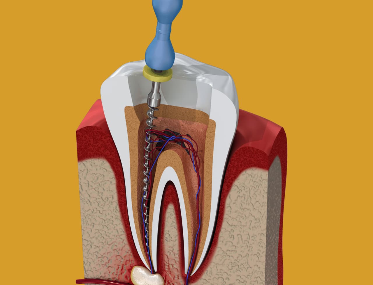 Root canal treatment