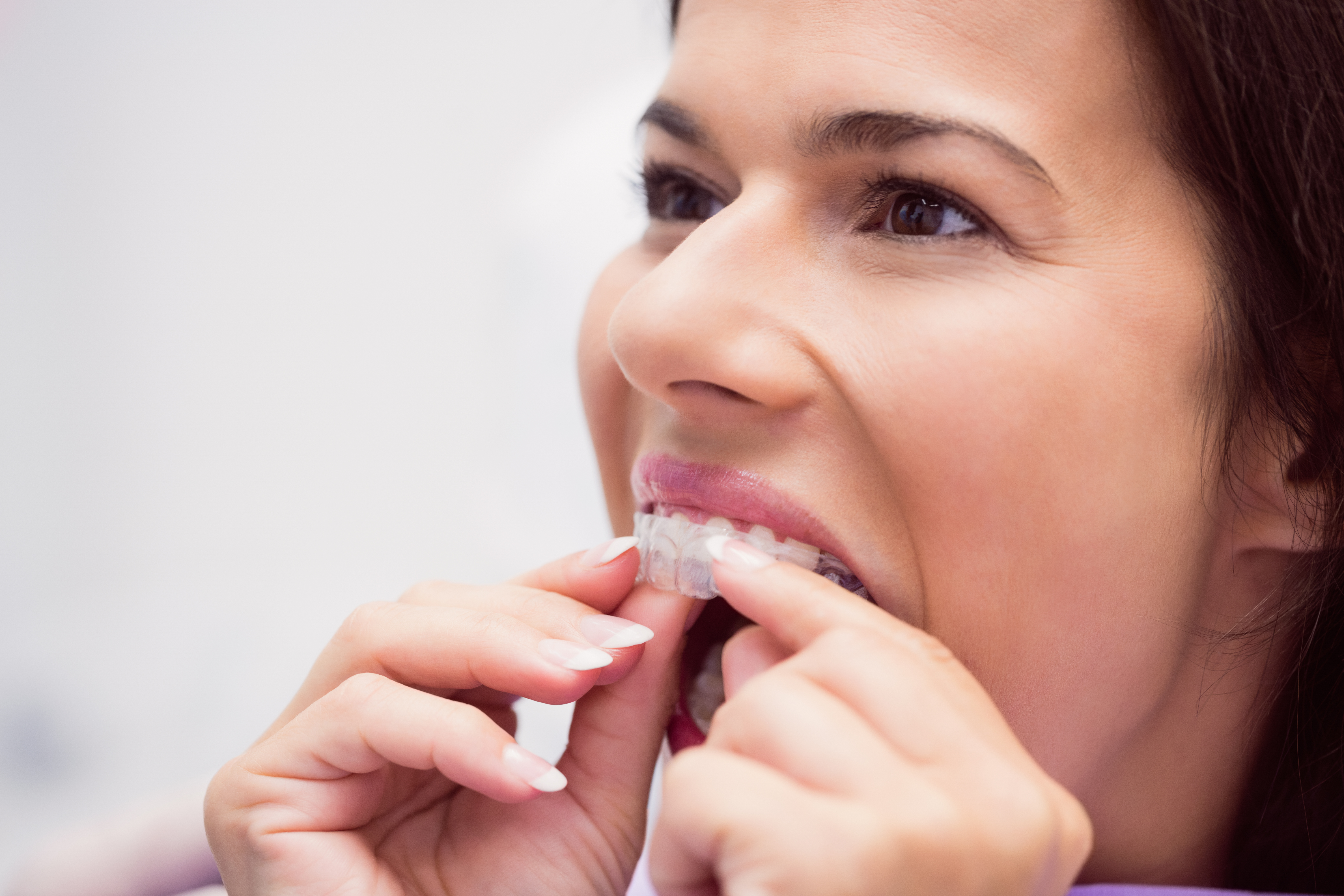 invisalign