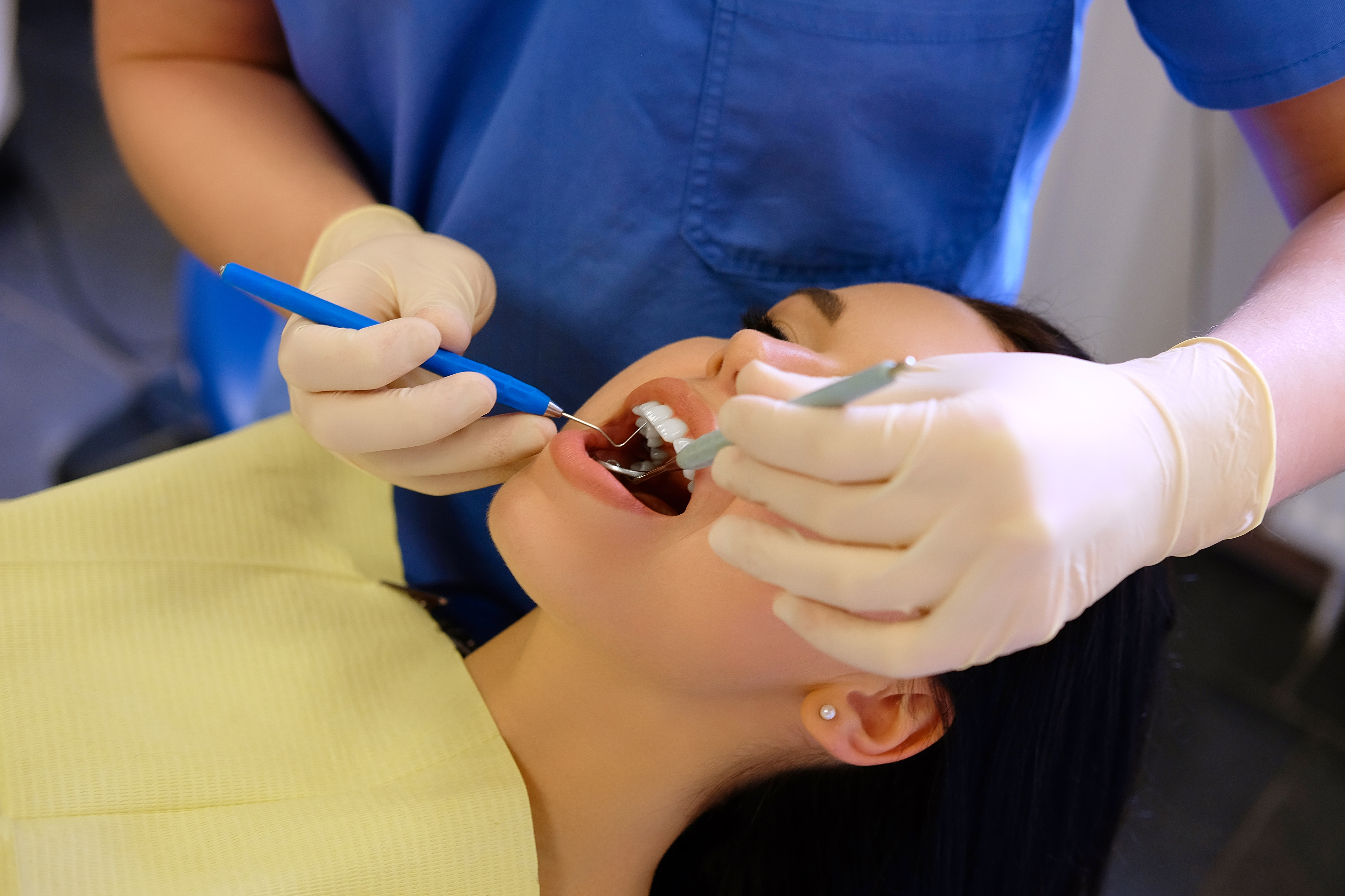 Dental Fillings