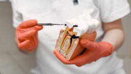 Dentist showing model of tooth with cavity